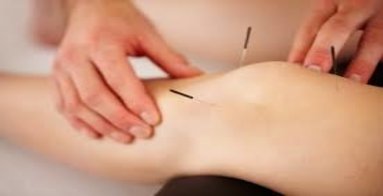 dry-needling-acupuncture